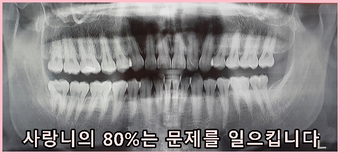  사랑니꼭뽑아야하나요?뽑고나서주의할점은?