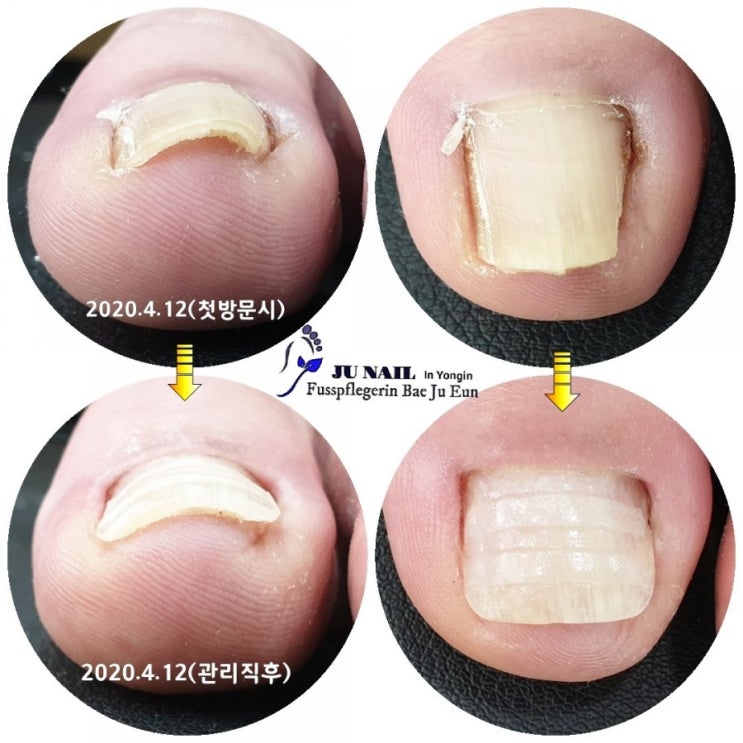 파고드는 내성발톱때문에 발톱수술을 1년에 한번씩 6번이나 하셨어요./분당용인수원수지보정동백죽전동/주네일/무좀파고드는내향성발톱손톱변형전문네일샵