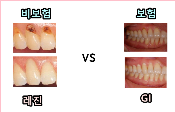  시린이치경부마모증보험치료VS비보험치료