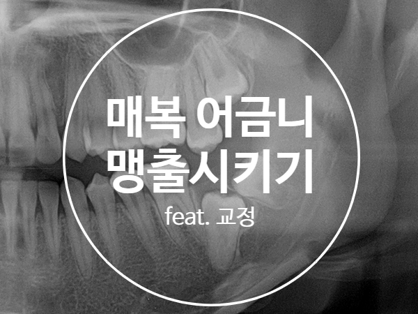 우리아이 영구치 어금니가 안나와요!(매복된 어금니 끌어올리기, feat. 교정), 영구치 살리기 프로젝트