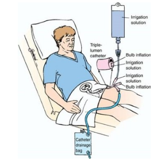 간헐적 방광 세척, 지속적 방광 세척 (Bladder Irrigation)