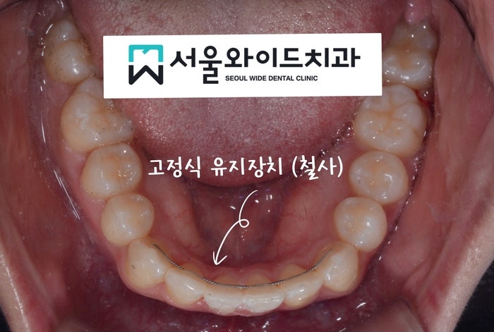 교정 후 유지장치 철사 제거는 언제? 탈락 및 레진 재부착, 치석 스케일링 : 네이버 블로그 교정 후 유지장치 철사 제거는 언제? 탈락 및 레진 재부착, 치석 스케일링 : 네이버 블로그