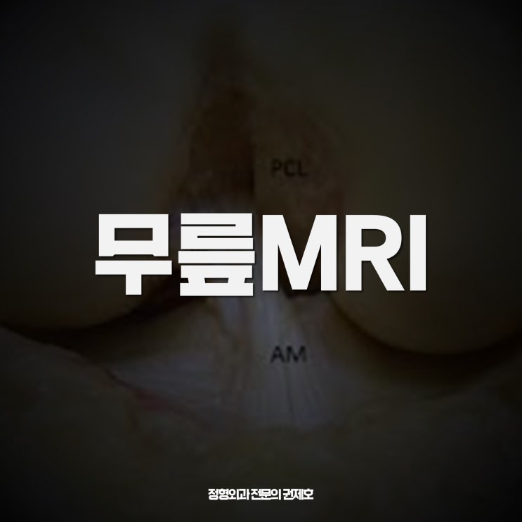 무릎 MRI 보는 방법! feat. 제이본정형외과 권제호