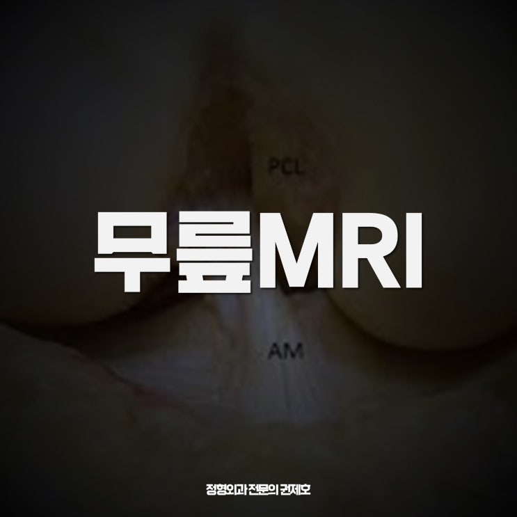  무릎 MRI 보는 방법! feat. 제이본정형외과 권제호