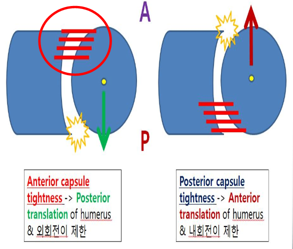 오십견에서 시리악스의 관절낭 패턴(capsular pattern)에 대한 임상적 의의 - 이학적 검사 오류 365마디척한의원 ...