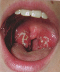 Tonsillitis prostatitisz kapcsolat