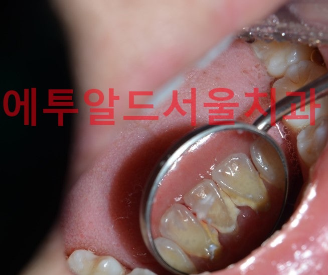 스케일링이 시린 걱정이라면? 4