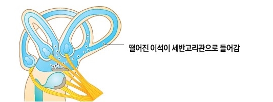 이석증치료생생후기이석증치료비용/이석증병원/왕십리이비인후과/왕십리이석증치료/건대입구이비인후과/뚝섬역이비인후과/연세이비인후과/