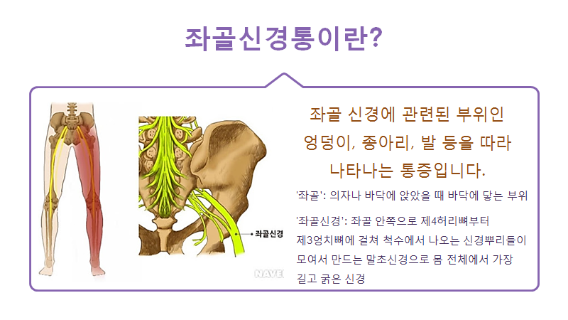 [광양병원 공식블로그] 좌골신경통의 예방과 치료 : 네이버 블로그