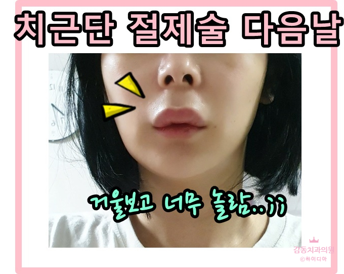  [당감동치과]크라운씌운치아뿌리염증,치근단절제술이란?