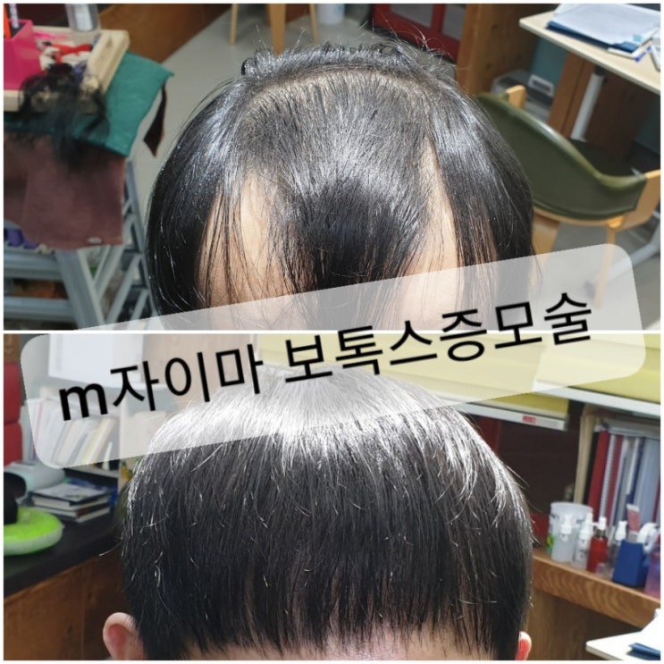  탈모고민 해결사! #보톡스증모술~ 너 왜 이제 나타났니~~~ㅎ
