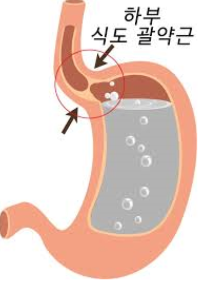  속쓰림원인 - 역류성식도염, GERD