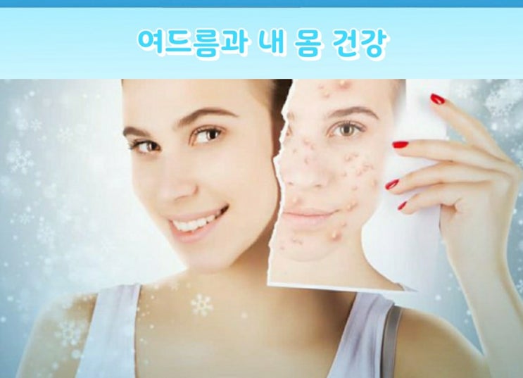  여드름과 내 몸 건강관계