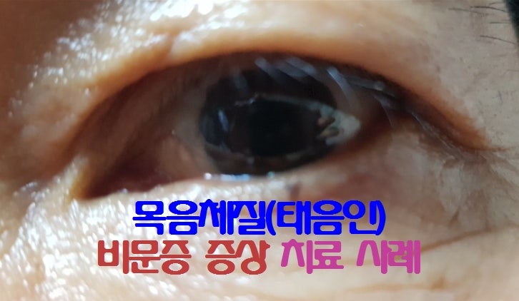 날파리증? 비문증 증상 목음체질(태음인) 치료 사례