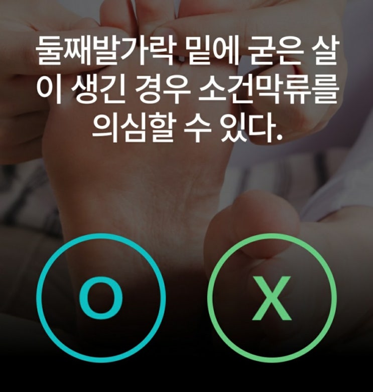  발가락 질병 소건막류 의심 증상