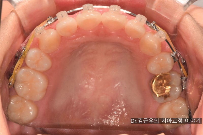치아교정 유지장치 관리법과 착용 기간 : 네이버 블로그