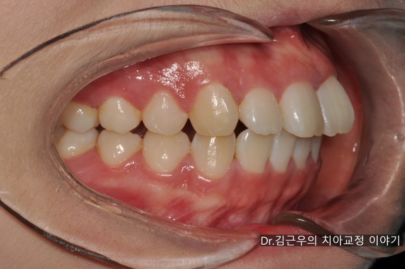 치아교정 유지장치 관리법과 착용 기간 : 네이버 블로그 치아교정 유지장치 관리법과 착용 기간 : 네이버 블로그