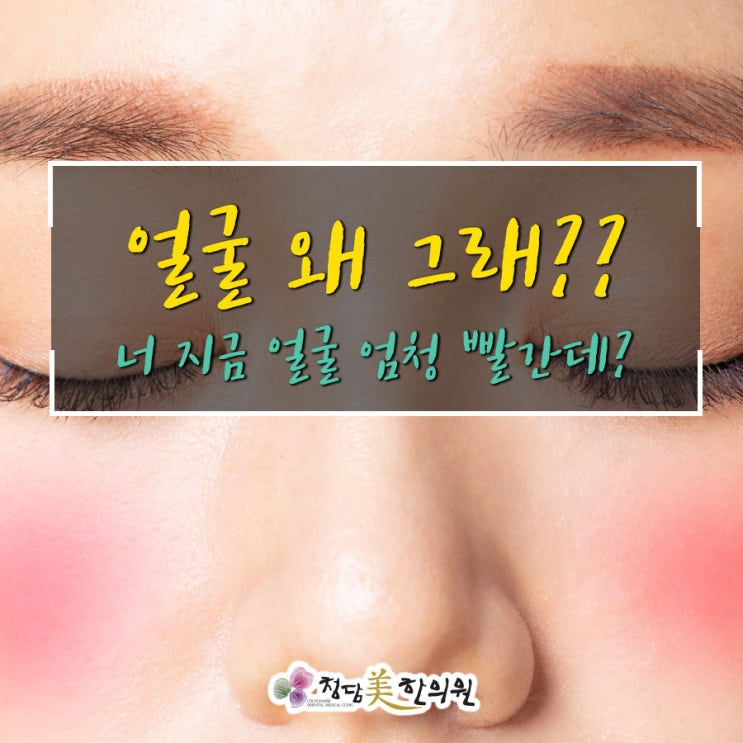얼굴이 뜨거운 증상. 안면부열감 안면홍조는 한방체질치료로 해결가능합니다. 얼굴이 뜨거운 증상. 안면부열감 안면홍조는 한방체질치료로 해결가능합니다.