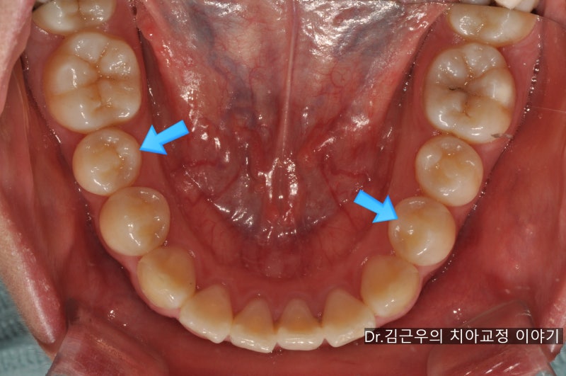 치아교정 유지장치 관리법과 착용 기간 : 네이버 블로그 치아교정 유지장치 관리법과 착용 기간 : 네이버 블로그