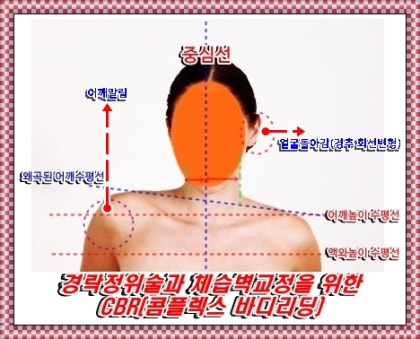 어깨 비대칭 교정이 필요한 경우