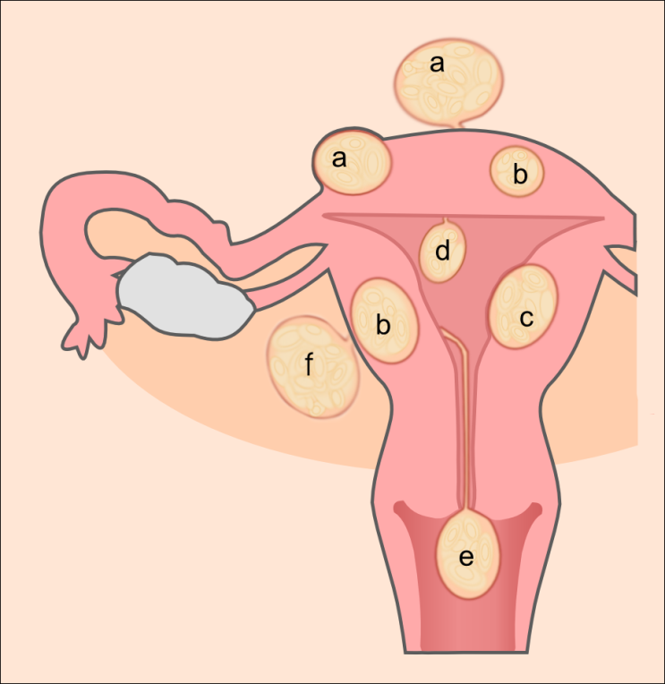 [여의도 여성한의원] 자궁근종 한방치료로 관리할 수 있습니다