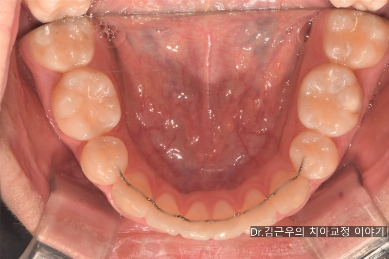치아교정 유지장치 관리법과 착용 기간 : 네이버 블로그