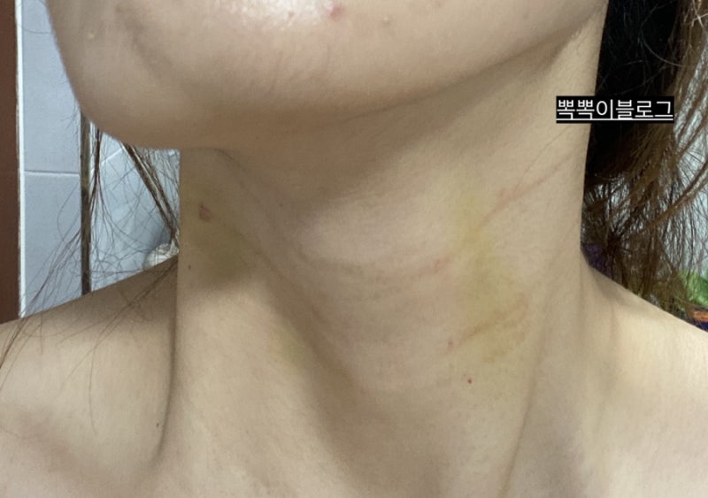 목주름필러 목주름레이저 벨레넥스 비포&애프터 / 케어 / 부작용후기