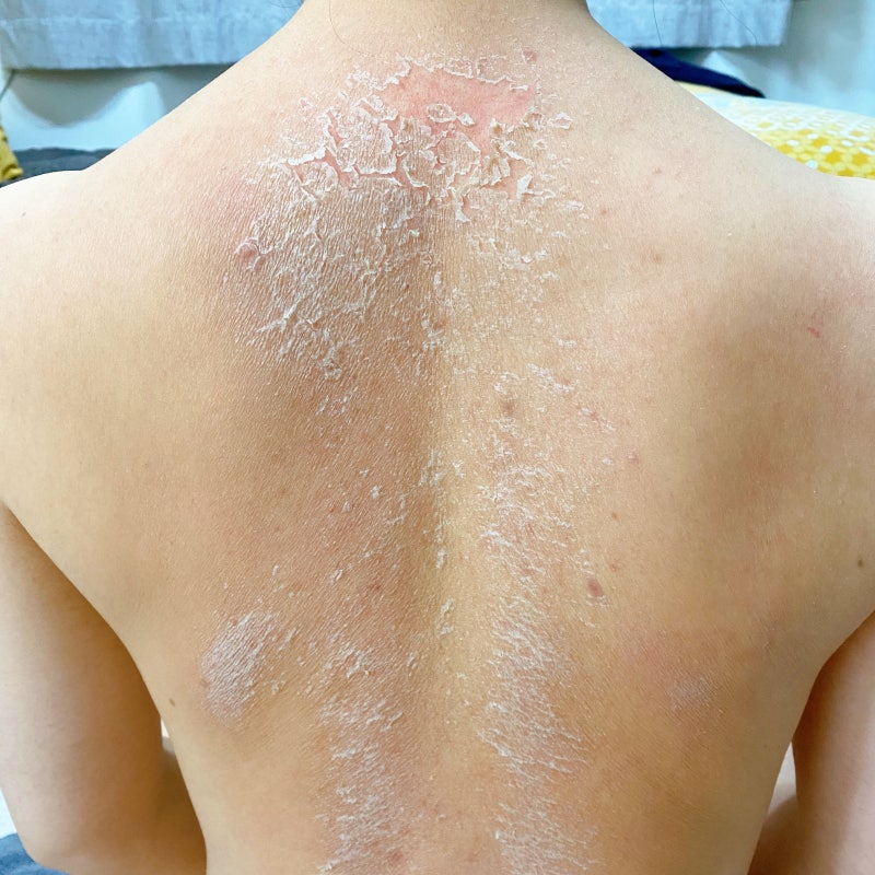 일산 가드름 때문에 피부과 알아보고 9