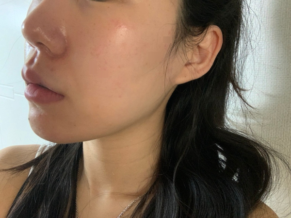  내돈내산 레가토2리얼후기 :: 레가토2+PDRN연어주사 + 크라이오셀 내돈 후기 / PRP내돈 후기