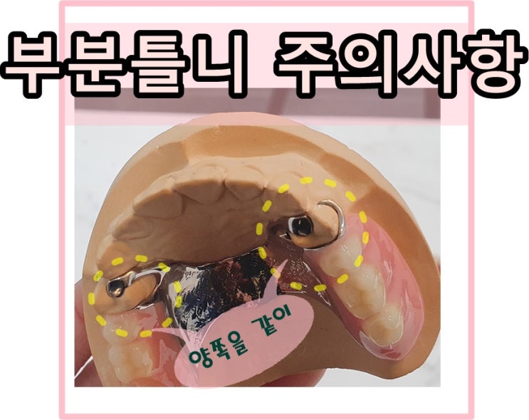  당감동치과부분틀니사용시주의해야할사항