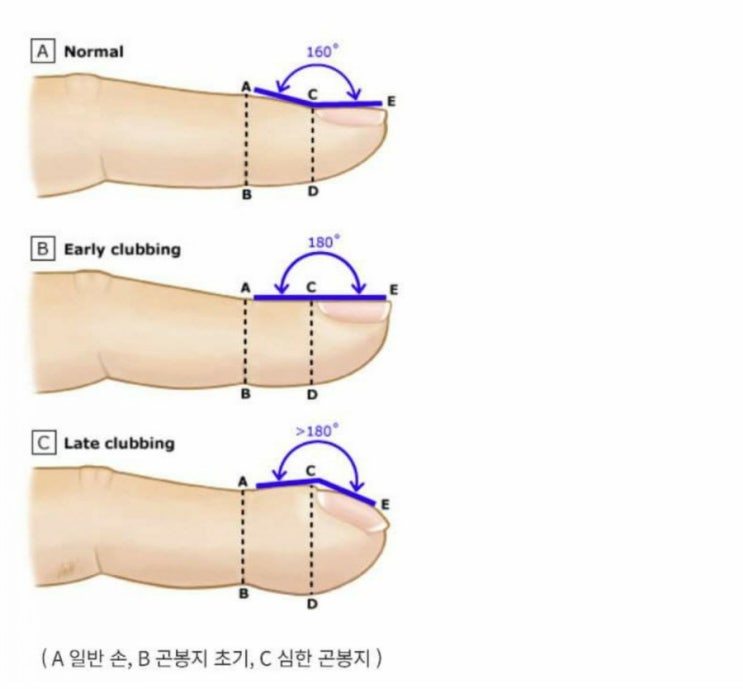 [지로그] 손가락을 이용한 간단한 폐질환 검사법