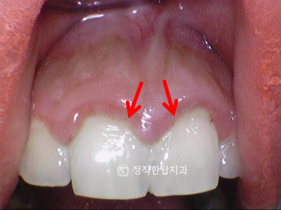 임신과 치과 진료, 임신 전에 꼭 치과를!