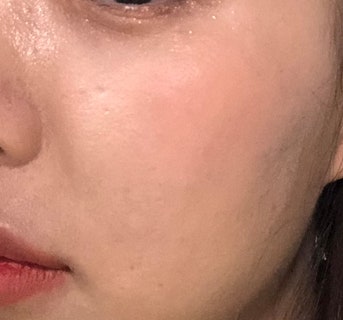 남성 턱수염탈모레이저 5회차/EXO좀주사,여드름피부흉터관리시크릿rf레이저 10