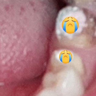  어금니 신경치료 통증과 치아생명 지키기 어렵다