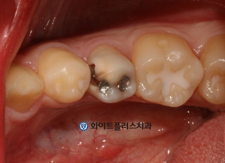  보라매 치과 충치로 인한 극심한 치통의 신경치료