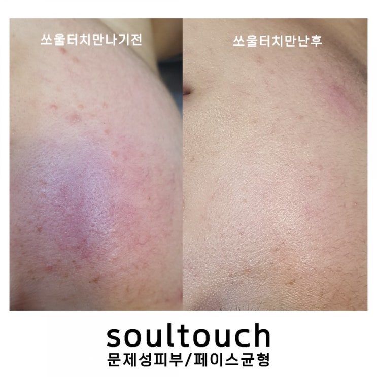  민감한 피부관리 어떻게 하지? 고민인가요?