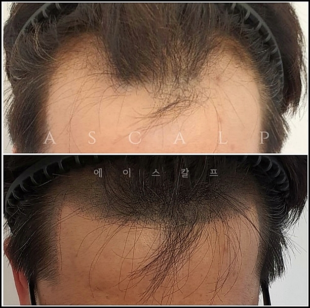  엠자이마문신 울산에이스칼프 풍성해보이는 머리숱