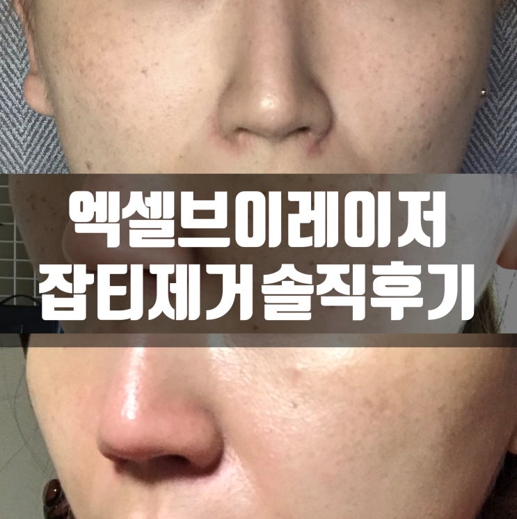 [내돈내받] 엑셀브이레이저!! 기미 주근깨 잡티 제거에 효과대박 리얼솔직후기