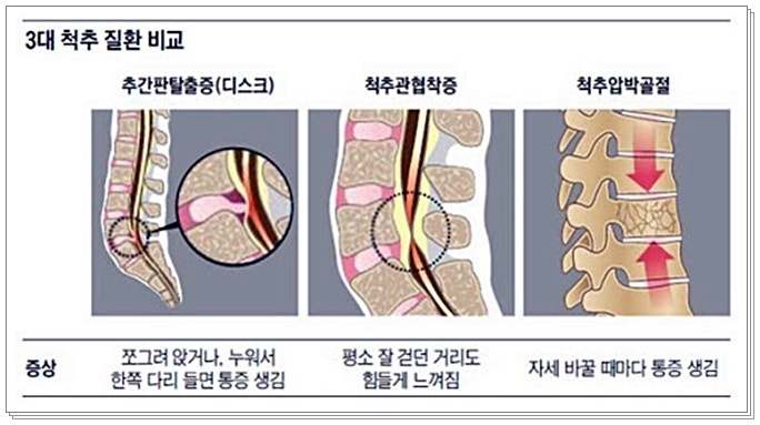 일반적인 요통(척추 협착증) 수술 클레임