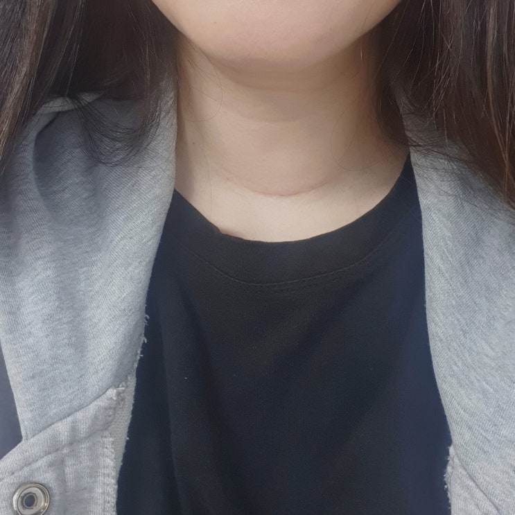  갑상선암 수술 10개월 후