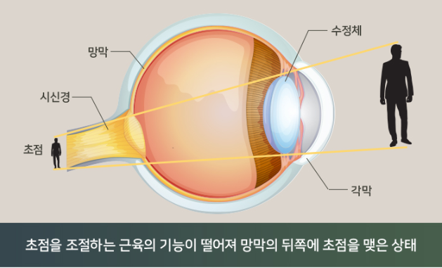 노안라식수술 노안수술잘하는곳 찾는다면 10