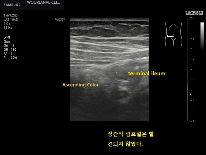 급성기간을 벗어나는? 상복부 경련성 통증, 우하복부 압통, 정상충수돌기, 장간막림프절염에 준해 치료, 증상 추적 - 동대문구 ...