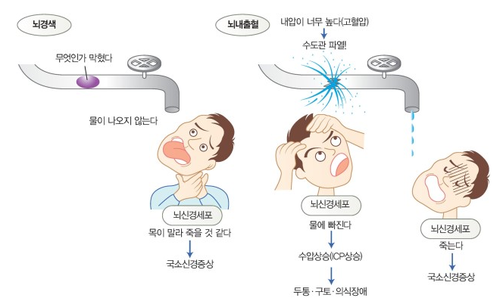  뇌혈관 뇌졸중 뇌경색 뇌출혈 진단비 대하여 알아보기