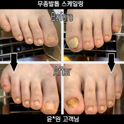 부천무좀발톱 전문샵추천! 페디아이티엔에서 아기발로!!