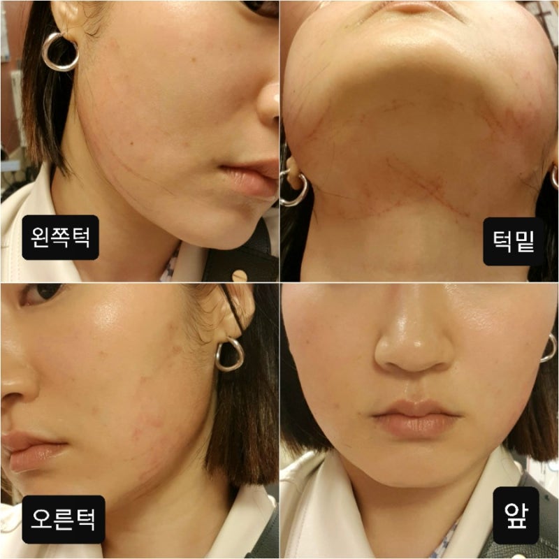 잠실새내피부과에서 잡티제거레이저 인모드 시술 받은 후기 (인모드통증)