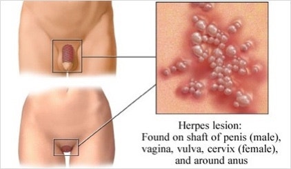 여성 헤르페스 2형 증상 완치 전염 바이러스 검사법까지 알려드립니다.