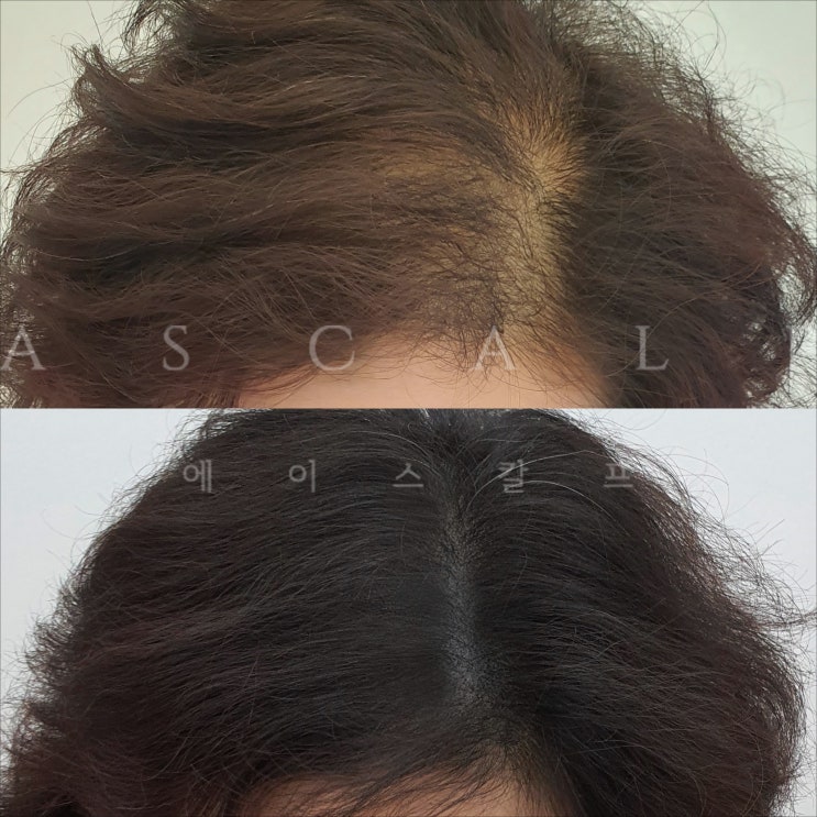  포항두피문신 에이스칼프 디테일이 남달라
