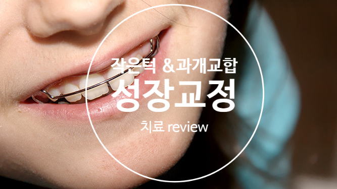 성장중인 우리아이 작은턱 & 과개교합(깊게물리는 아이) 치료 리뷰 (올바른 턱성장 교정) 성장중인 우리아이 작은턱 & 과개교합(깊게물리는 아이) 치료 리뷰 (올바른 턱성장 교정)