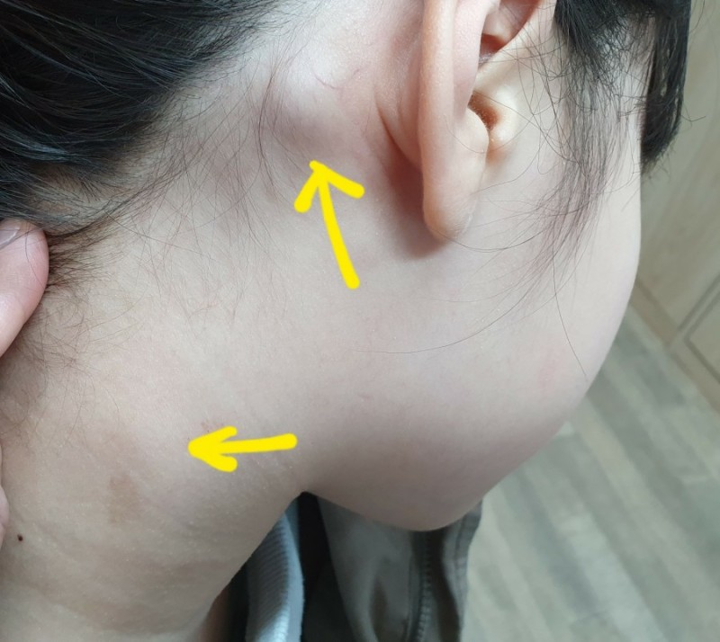 목에 혹이 만져질 때 귀 뒤에도 몽우리가 있을 때 목임파선염일까? 종양일까? : 네이버 블로그