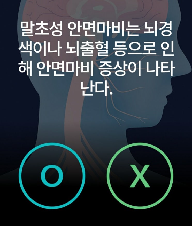  말초성 안면마비